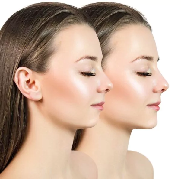 chin filler injection