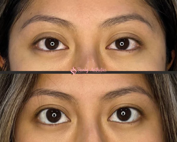lifting of the upper eyelids following Upneeq treatment
