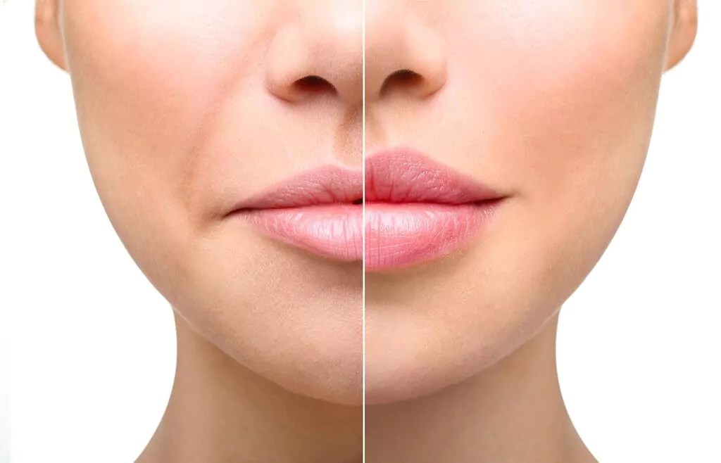 nasolabial fold filler injection