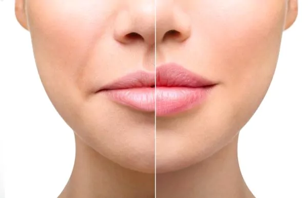 nasolabial fold filler injection