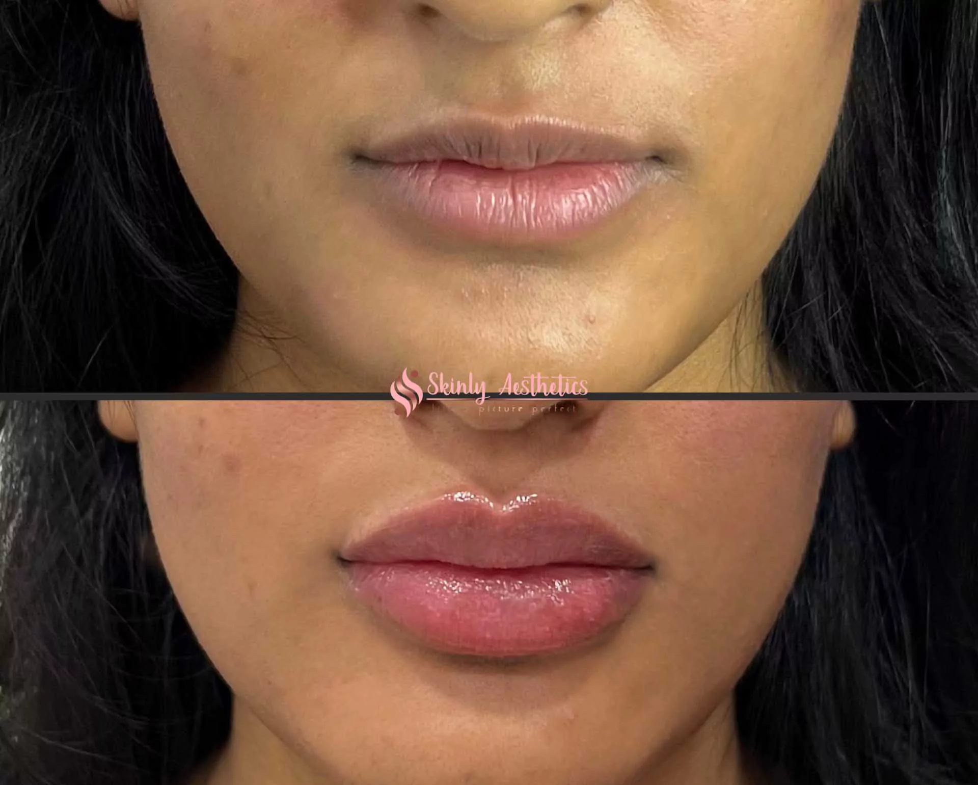 natural looking lip filler results with Juvederm Ultra injections