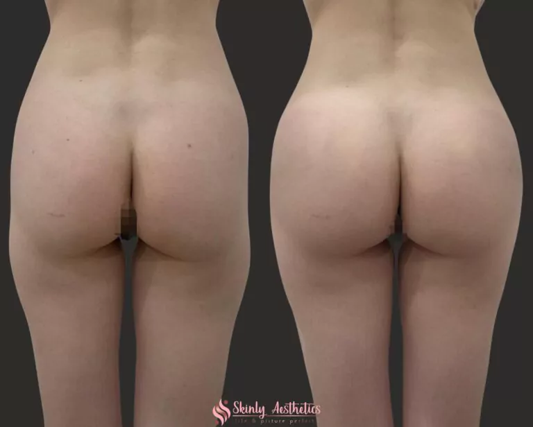 non surgical posterior butt augmentation with Sculptra and Radiesse dermal fillers