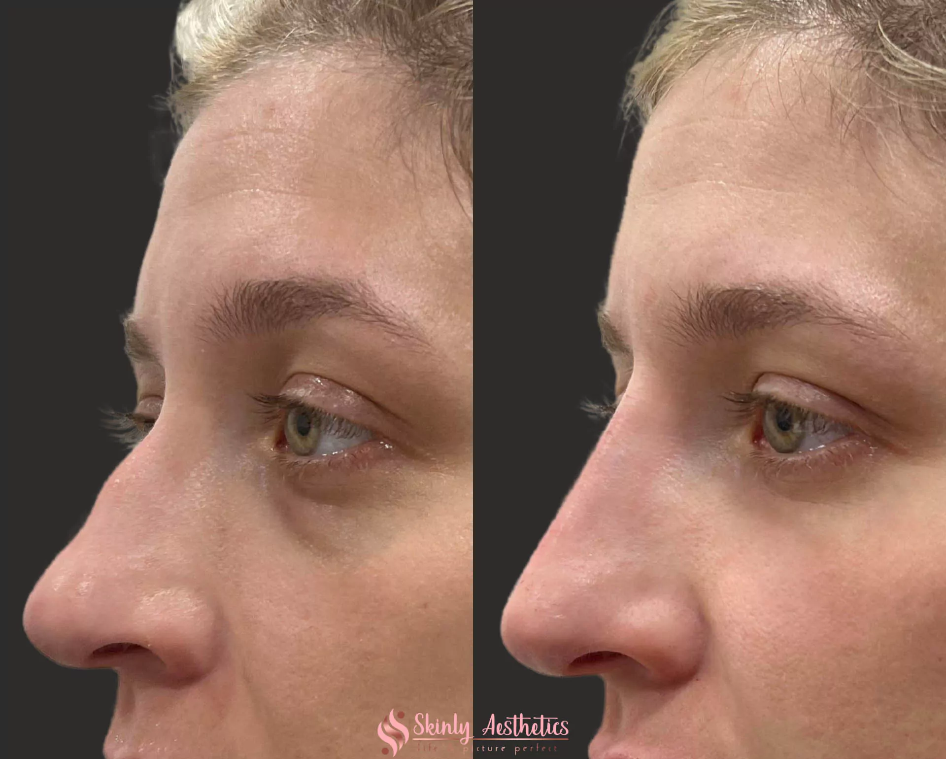 non surgical rhinoplasty results to fix crooked and bumpy nose