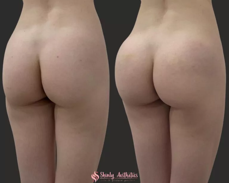 posterior butt sculpting via non surgical enhancement with Sculptra and Radiesse fillers