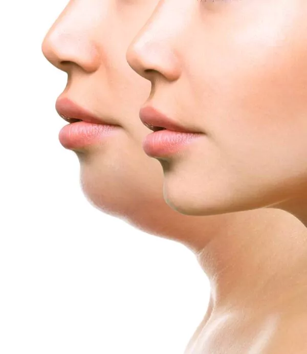 reduction of double chin with Kybella