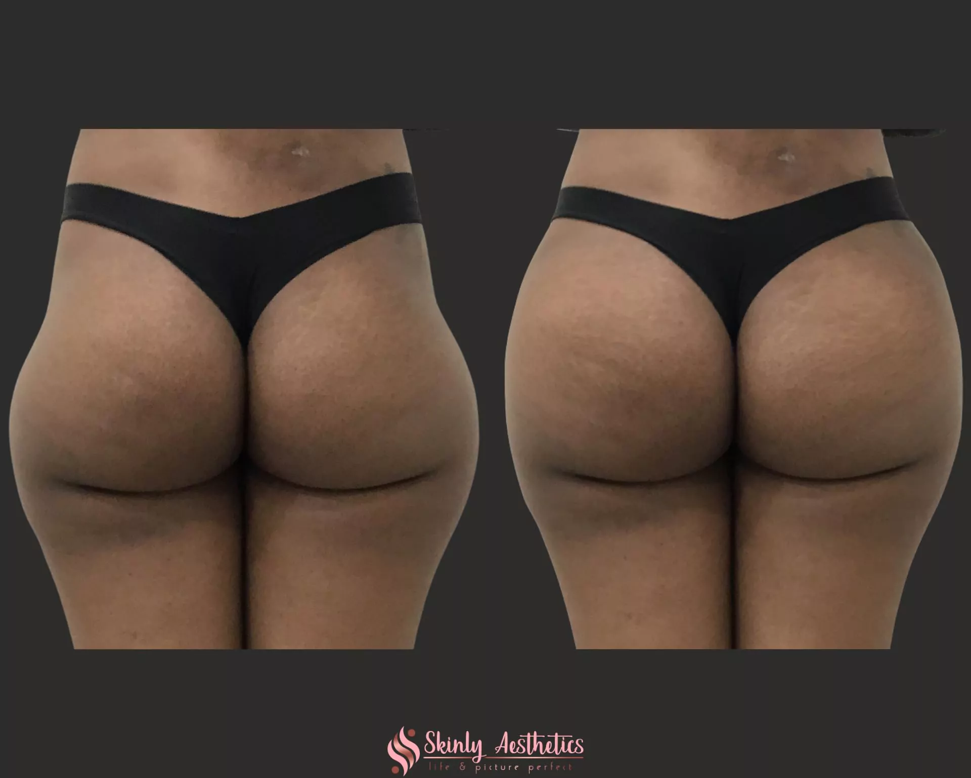 severe hip dip deformities corrected with Sculptra and Radiesse fillers
