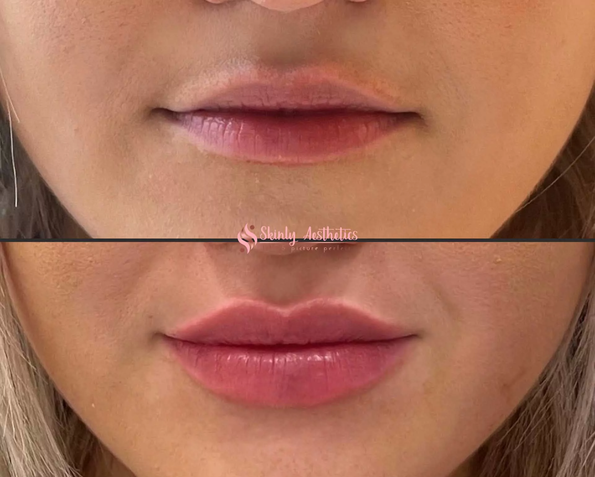 subtle lip filler augmentation with RHA2 filler