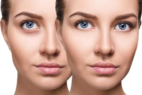 under eye filler procedure