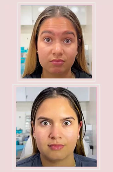 botox before and after video