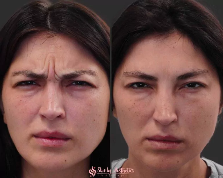 Best Botox treatment in NYC
