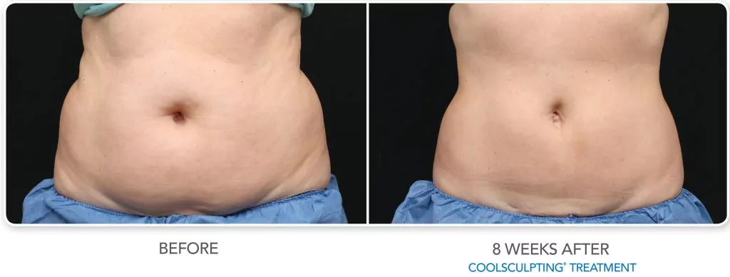 CoolSculpting Before and After Results on Abdomen