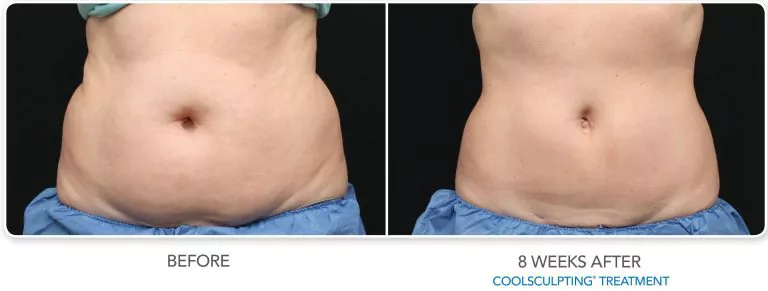 CoolSculpting Before and After Results on Abdomen