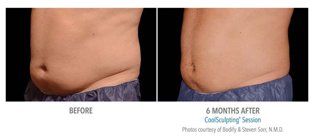 CoolSculpting Before and After