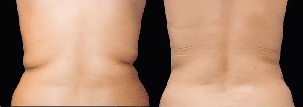 CoolSculpting treatment NYC