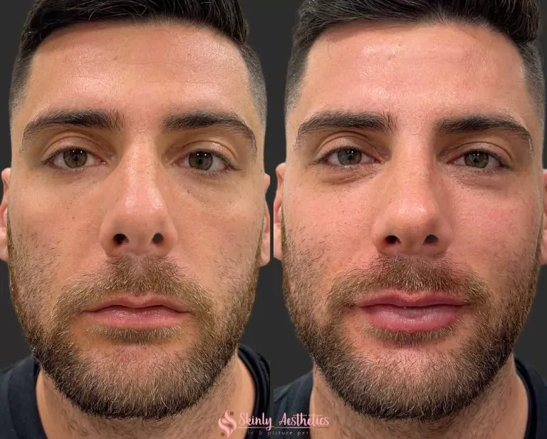Male Lip Filler Before After Results