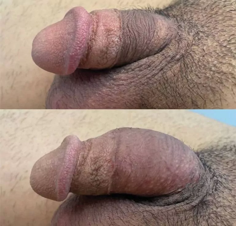 Penis Injections Before and After