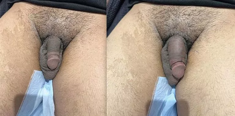 Penis Filler Injections Before And After