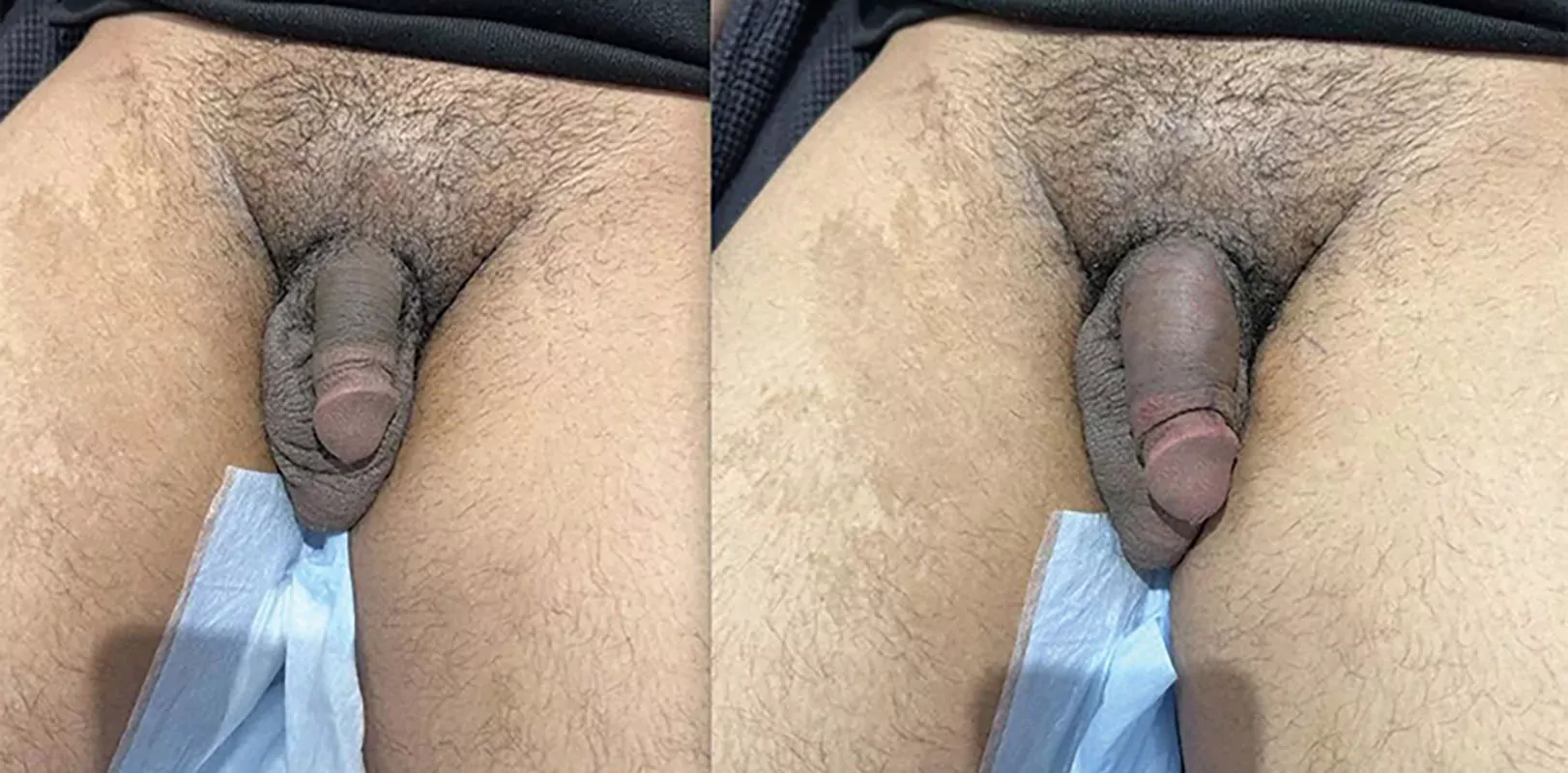 Penis Filler Injections Before And After