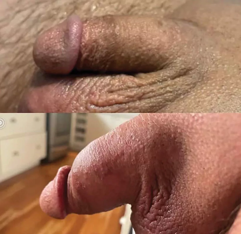 Penile Dermal Filler Augmentation