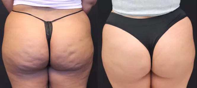 Before and after Avéli cellulite treatment on the buttocks