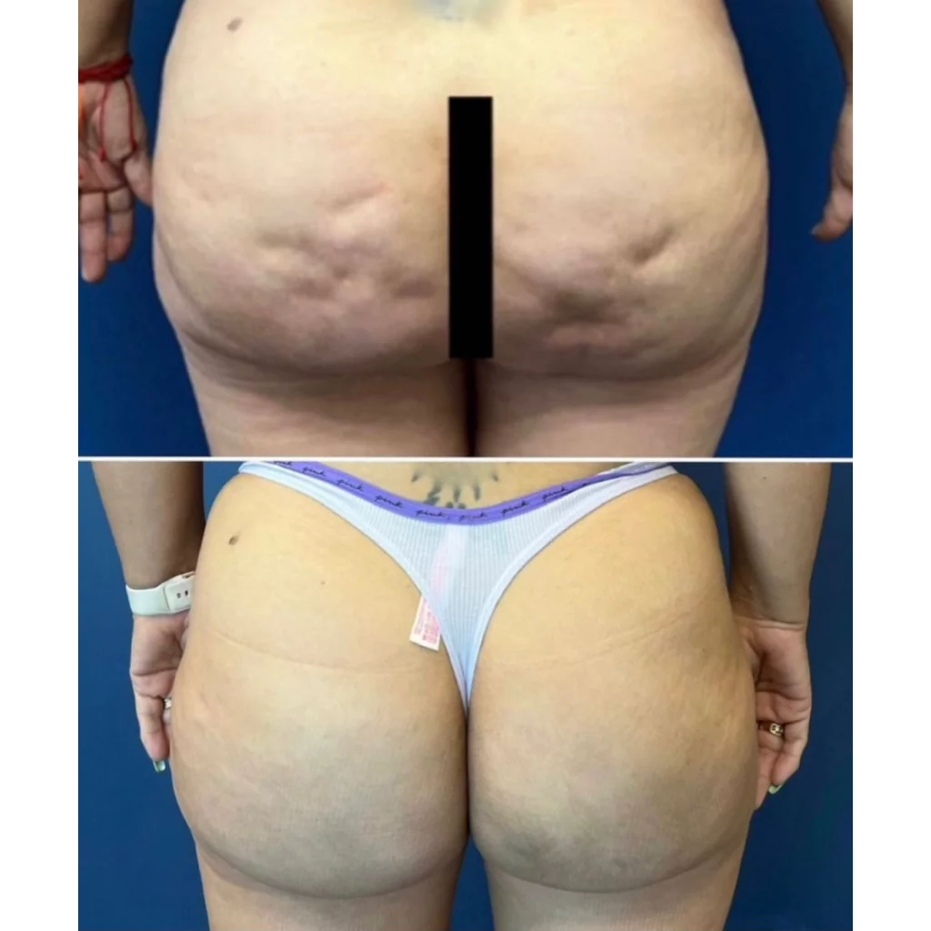 Smooth skin on the butt after Aveli cellulite reduction