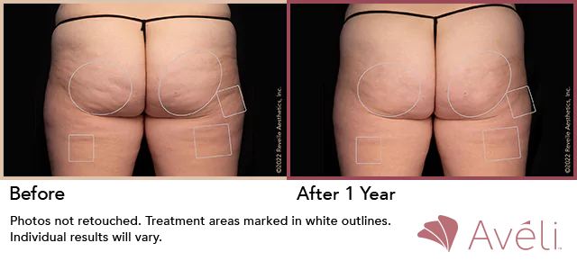 Before and after results of Avéli on buttocks showing dimple elimination