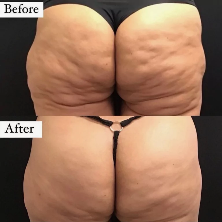 Avéli cellulite reduction on the buttocks, before and after