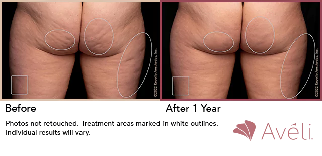 Avéli cellulite reduction on the butt, before and after