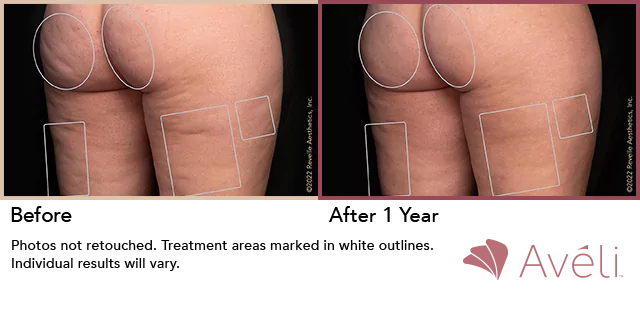 before and after results with cellulite free skin on the butt after Aveli