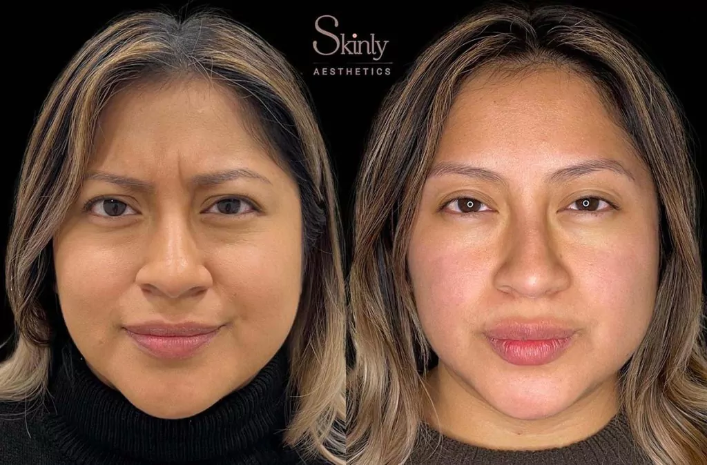 Before and after Botox results for glabellar lines (11s) in NYC