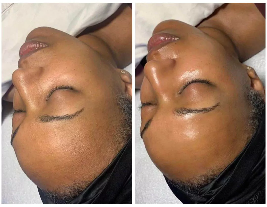 Hyadrafacial before and after results in New York