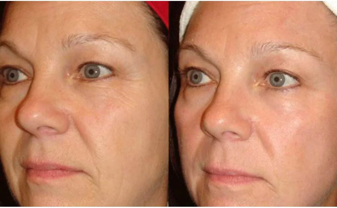 Microneedling results in New York