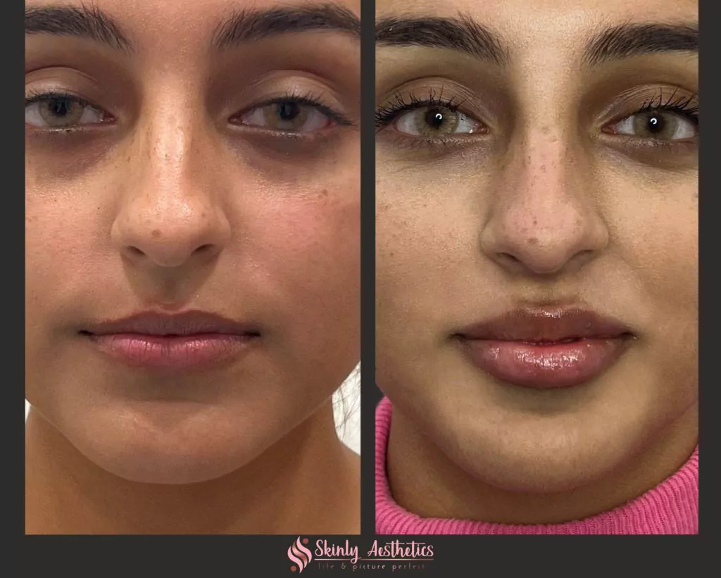 Lip filler before and after in NYC