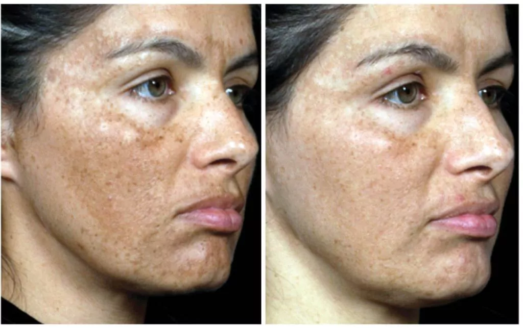 Before and after Fraxel Dual laser treatment for sun damage and pigmentation