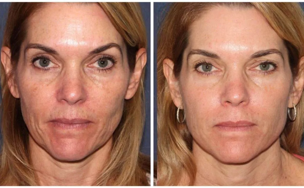 Before and after Fraxel Dual laser for fine lines and wrinkles