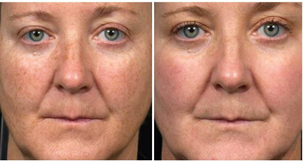 Fraxel Dual before and after sun spots results in NYC