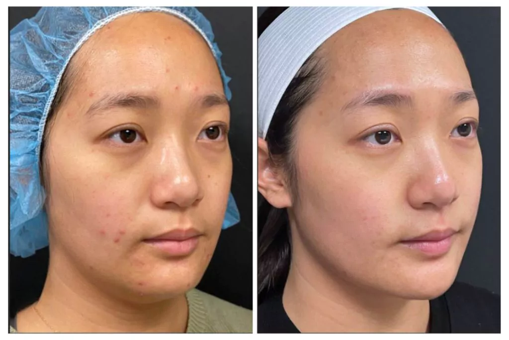 Before and after Morpheus8 RF Microneedling in NYC for acne scar reduction