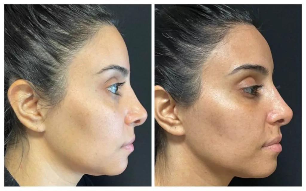 Before and after Morpheus8 RF Microneedling in NYC