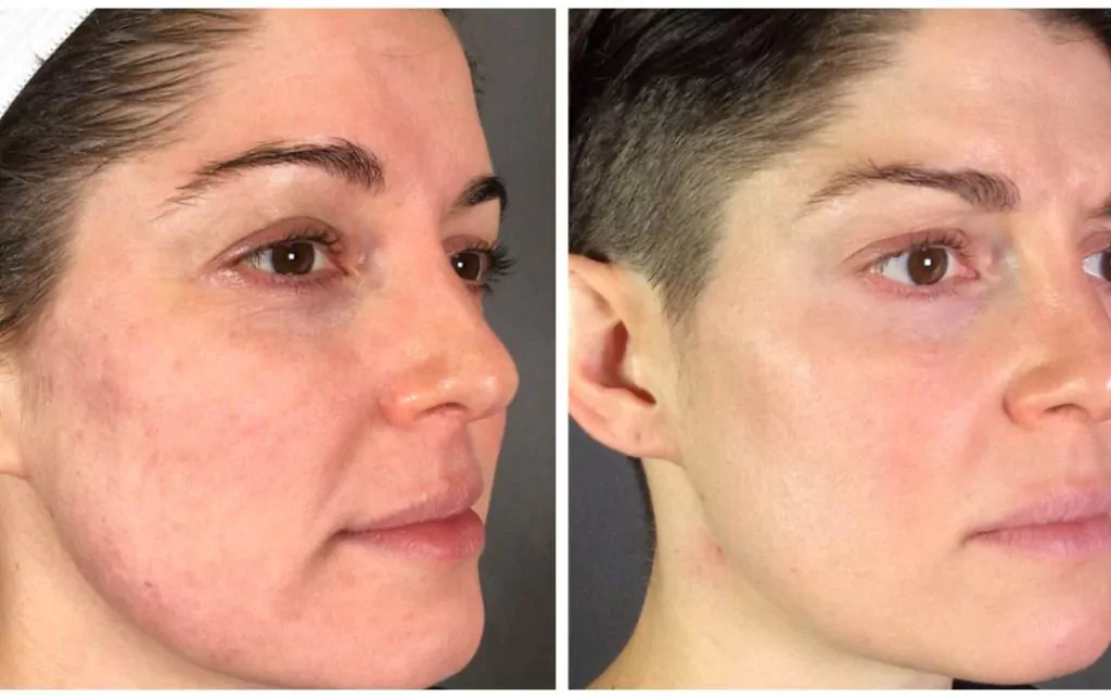 Before and after Secret RF Microneedling for acne scar reduction in NYC