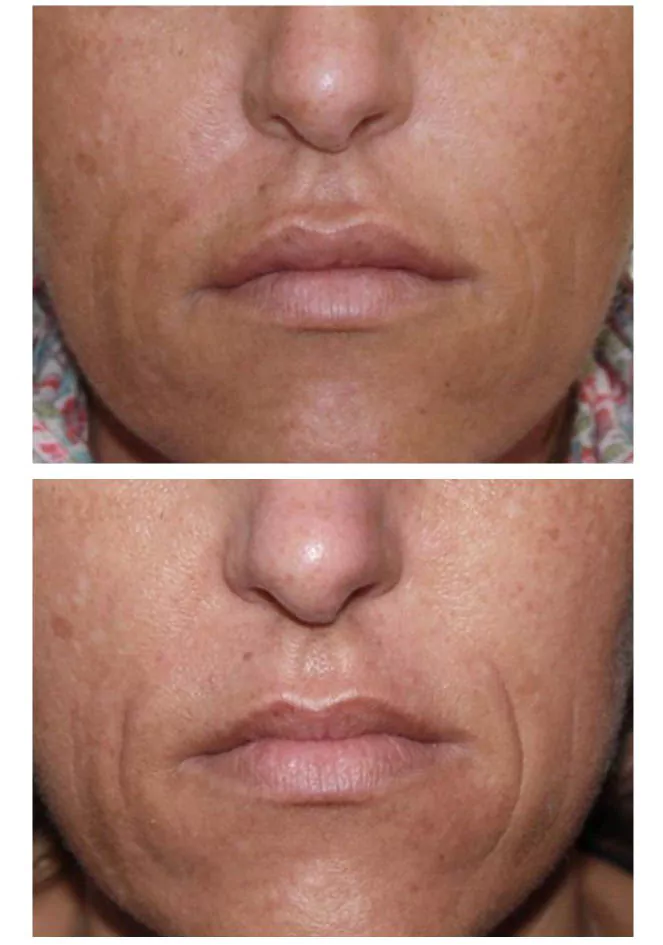 Before and after Secret RF Microneedling with reduced wrinkles and improved texture