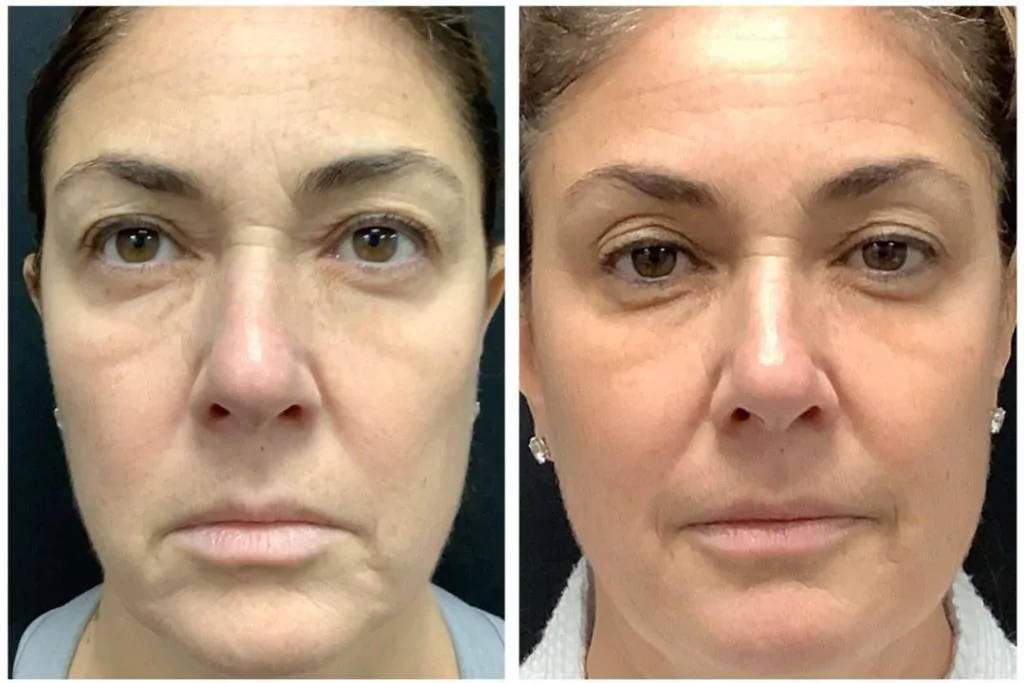 Before and after Secret RF Microneedling in NYC