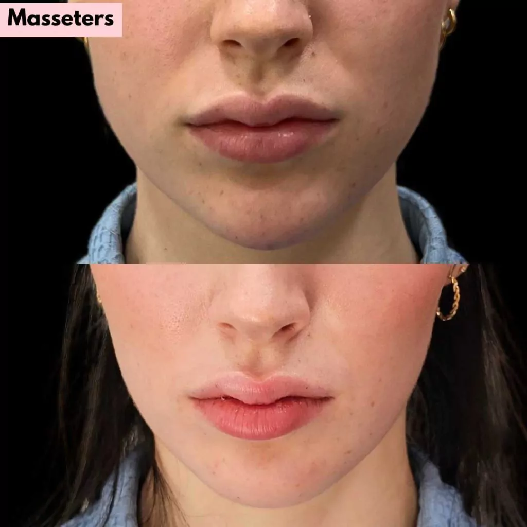 Botox TMJ Before and After Results