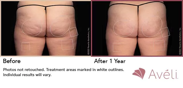 Before and after results of Avéli on buttocks