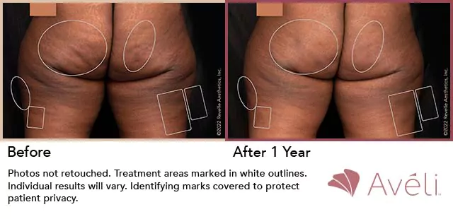 before and after Aveli cellulite reduction in buttocks & hips