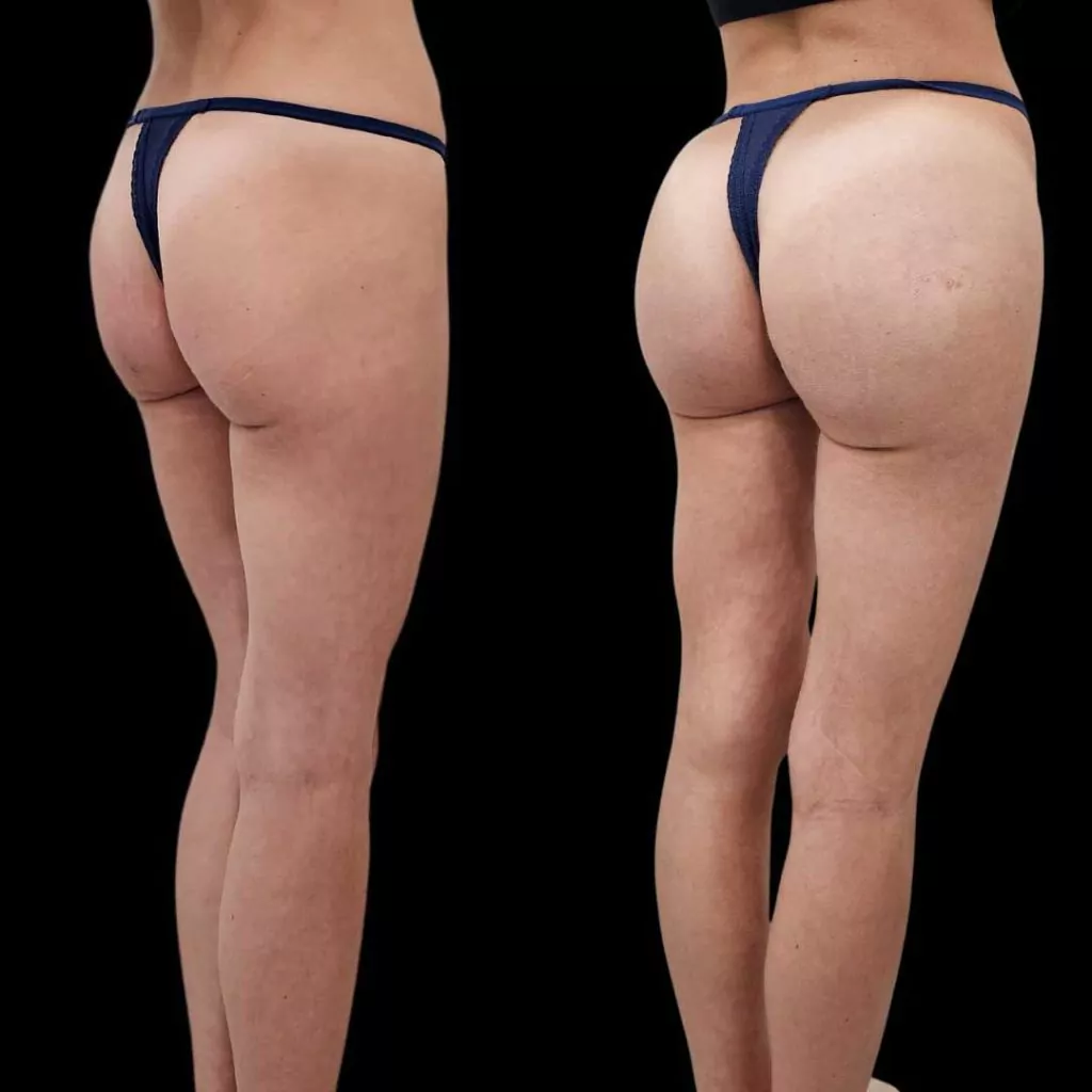 Before and after results Aveli cellulite reduction and butt lift