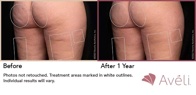 before and after results with cellulite-free skin on the butt