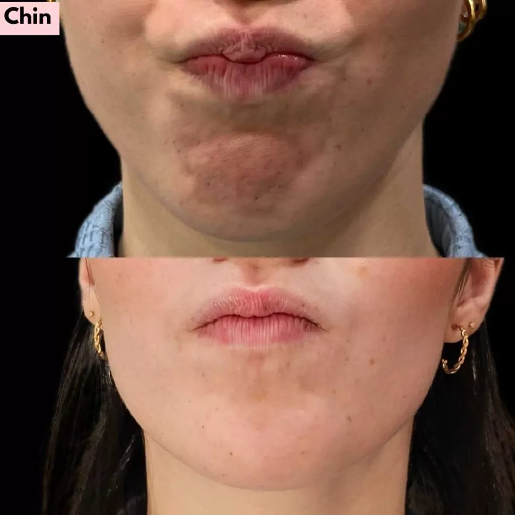 Smooth chin after Botox treatment