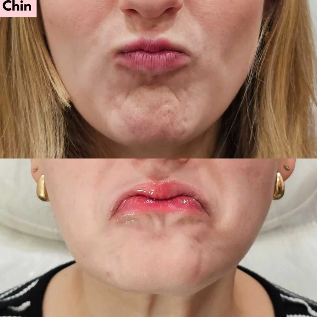 Smoothing of chin crease after Botox