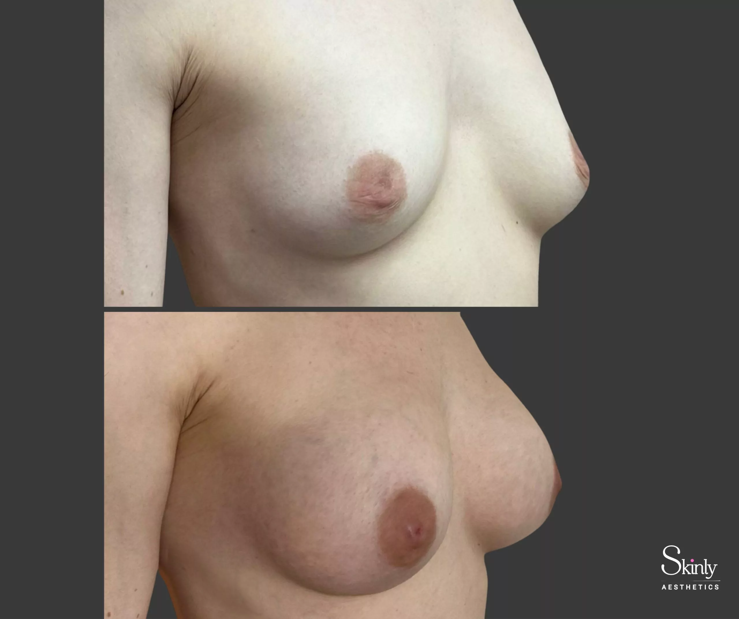Side-view results showing significant lift and improved breast contour