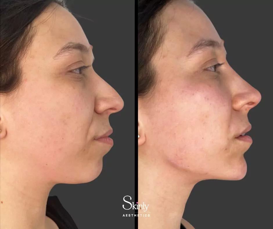 Endolift jawline results showing improved definition and reduction of jowls
